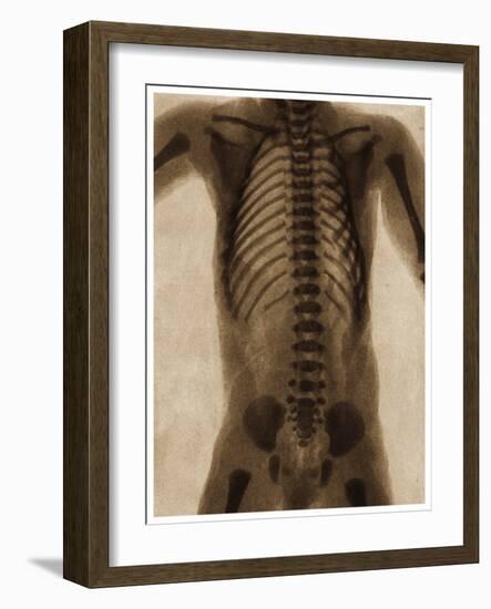 X Ray of a Human Torso C.1890-German School-Framed Giclee Print