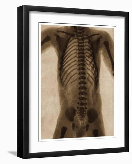 X Ray of a Human Torso C.1890-German School-Framed Giclee Print