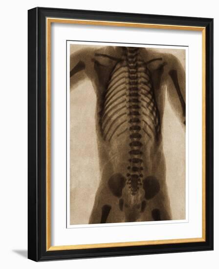 X Ray of a Human Torso C.1890-German School-Framed Giclee Print