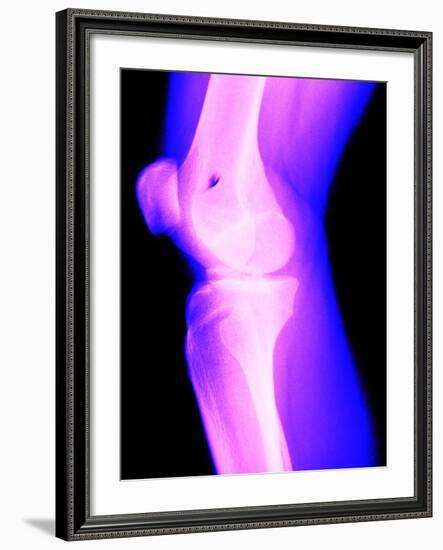 X-Ray of a Knee-null-Framed Photographic Print