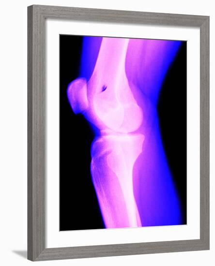 X-Ray of a Knee-null-Framed Photographic Print