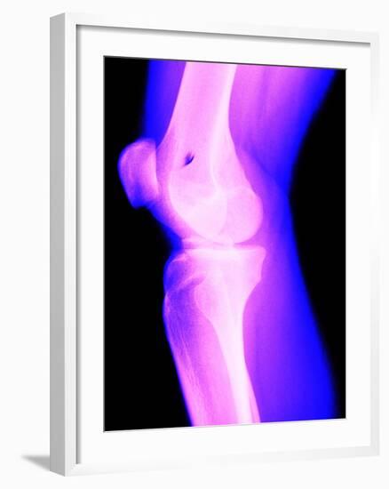 X-Ray of a Knee-null-Framed Photographic Print