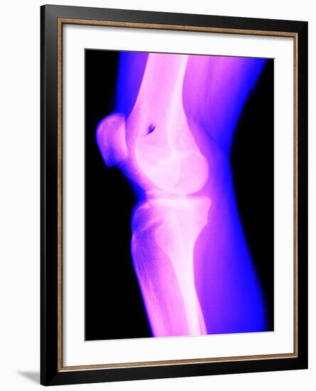 X-Ray of a Knee-null-Framed Photographic Print