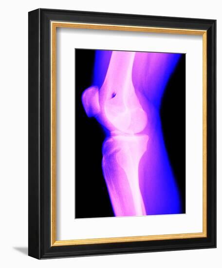 X-Ray of a Knee-null-Framed Photographic Print