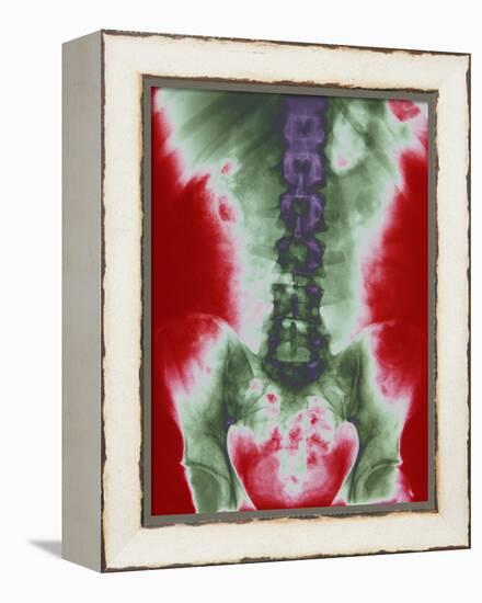 X-ray of a Torso-null-Framed Premier Image Canvas