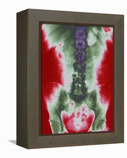 X-ray of a Torso-null-Framed Premier Image Canvas