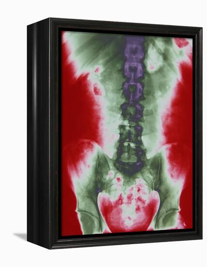 X-ray of a Torso-null-Framed Premier Image Canvas