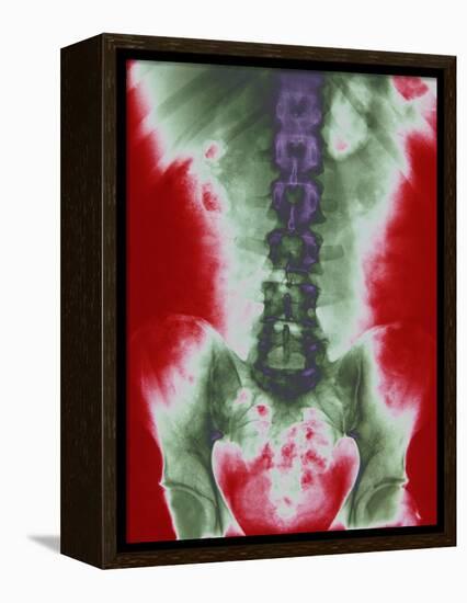 X-ray of a Torso-null-Framed Premier Image Canvas