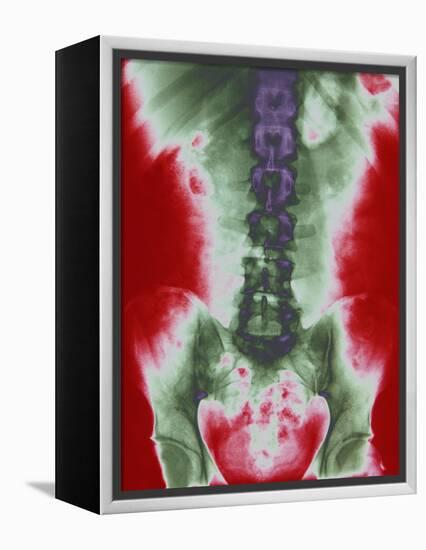 X-ray of a Torso-null-Framed Premier Image Canvas