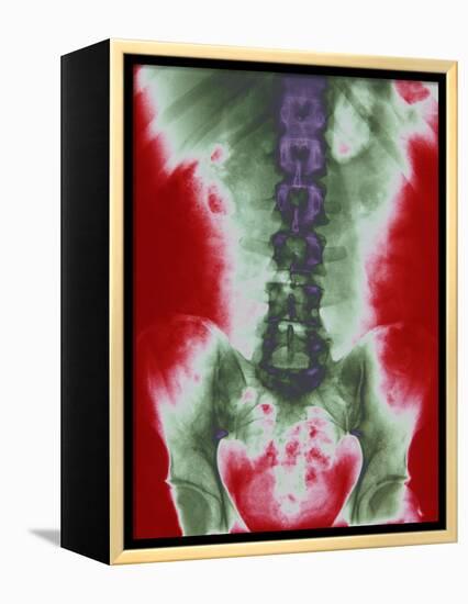 X-ray of a Torso-null-Framed Premier Image Canvas