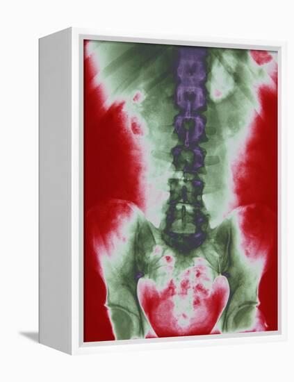 X-ray of a Torso-null-Framed Premier Image Canvas