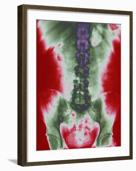 X-ray of a Torso-null-Framed Photographic Print