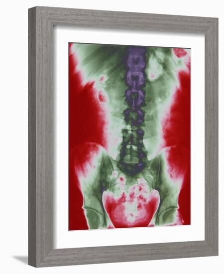 X-ray of a Torso-null-Framed Photographic Print