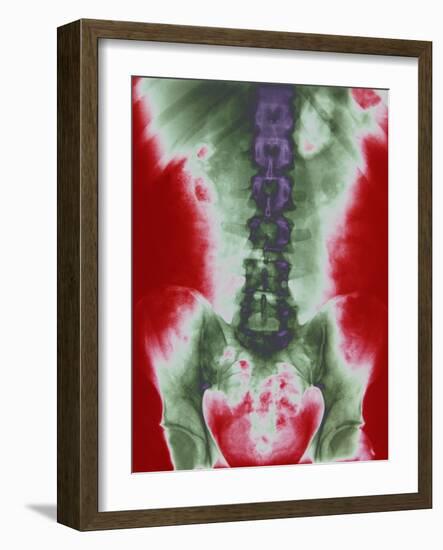 X-ray of a Torso-null-Framed Photographic Print