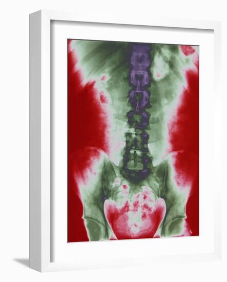 X-ray of a Torso-null-Framed Photographic Print