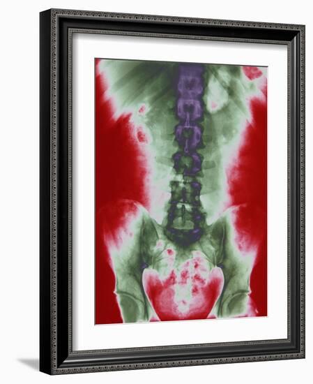 X-ray of a Torso-null-Framed Photographic Print