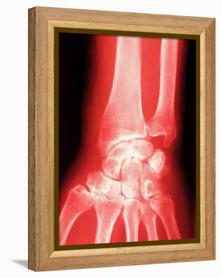 X-ray of a Wrist-null-Framed Premier Image Canvas