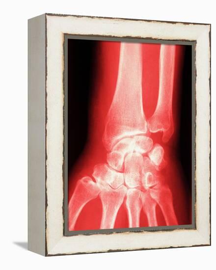 X-ray of a Wrist-null-Framed Premier Image Canvas