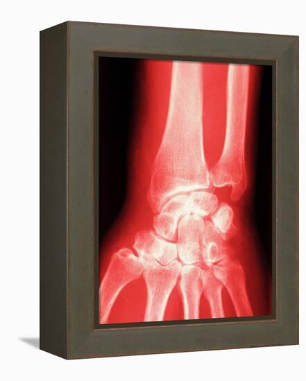 X-ray of a Wrist-null-Framed Premier Image Canvas