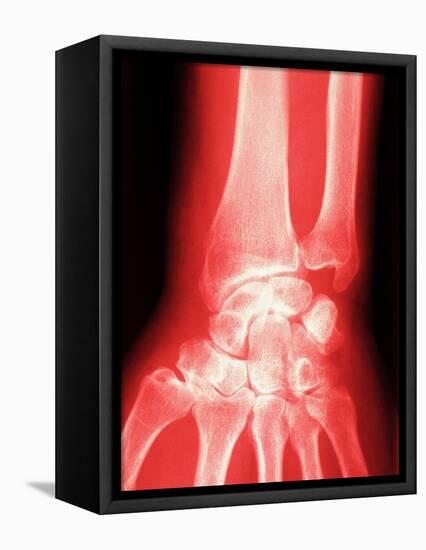 X-ray of a Wrist-null-Framed Premier Image Canvas