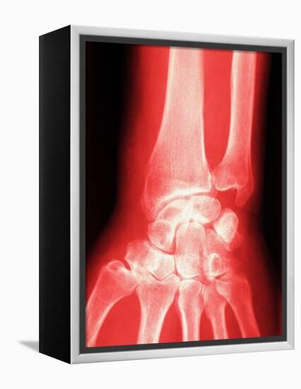 X-ray of a Wrist-null-Framed Premier Image Canvas