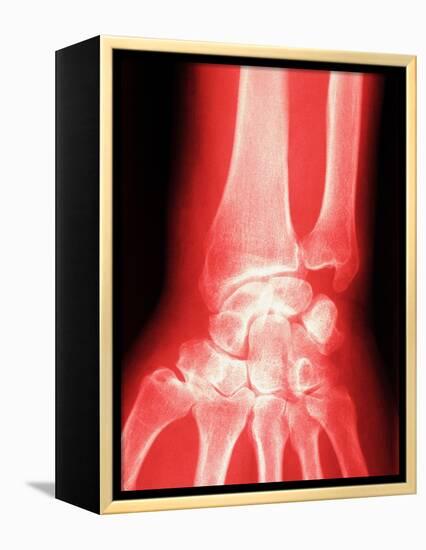 X-ray of a Wrist-null-Framed Premier Image Canvas