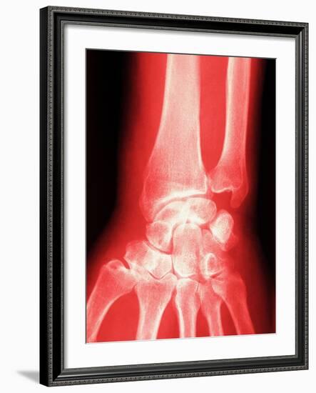 X-ray of a Wrist-null-Framed Photographic Print