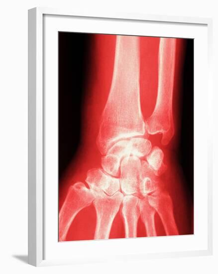 X-ray of a Wrist-null-Framed Photographic Print