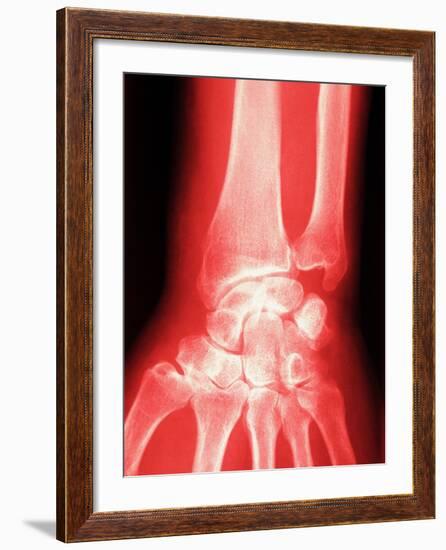 X-ray of a Wrist-null-Framed Photographic Print