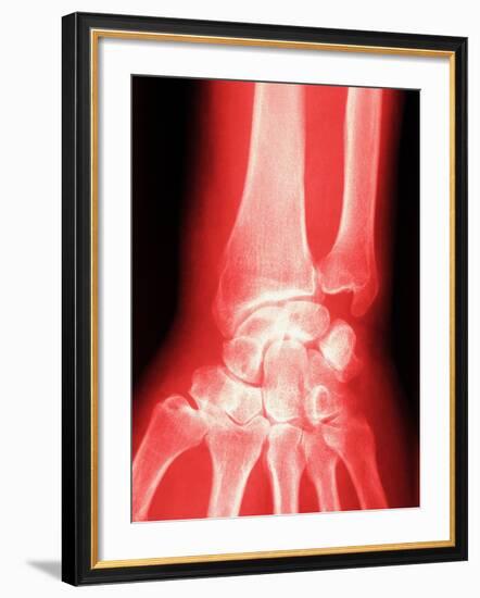 X-ray of a Wrist-null-Framed Photographic Print