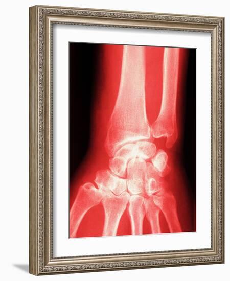 X-ray of a Wrist-null-Framed Photographic Print