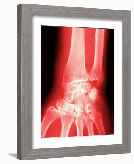 X-ray of a Wrist-null-Framed Photographic Print