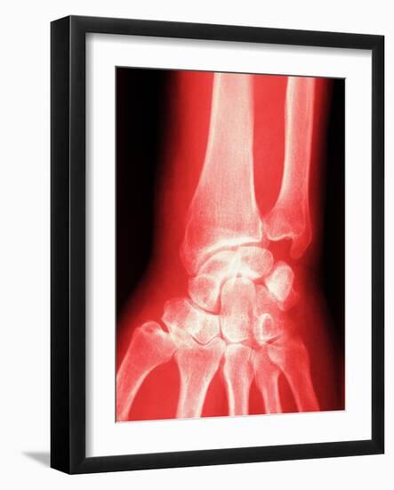 X-ray of a Wrist-null-Framed Photographic Print