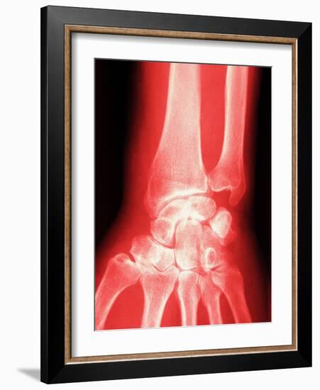 X-ray of a Wrist-null-Framed Photographic Print