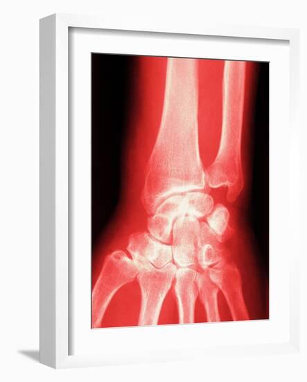 X-ray of a Wrist-null-Framed Photographic Print