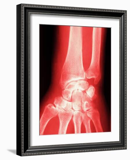 X-ray of a Wrist-null-Framed Photographic Print