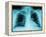 X-Ray of Dark Lungs-Robert Llewellyn-Framed Premier Image Canvas