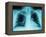 X-Ray of Dark Lungs-Robert Llewellyn-Framed Premier Image Canvas