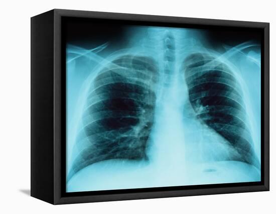 X-Ray of Dark Lungs-Robert Llewellyn-Framed Premier Image Canvas