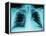 X-Ray of Dark Lungs-Robert Llewellyn-Framed Premier Image Canvas