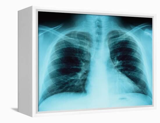 X-Ray of Dark Lungs-Robert Llewellyn-Framed Premier Image Canvas