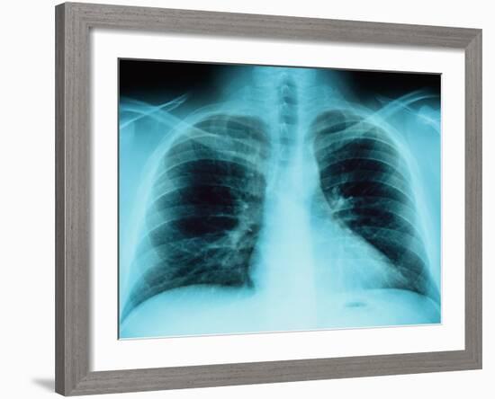 X-Ray of Dark Lungs-Robert Llewellyn-Framed Photographic Print