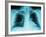 X-Ray of Dark Lungs-Robert Llewellyn-Framed Photographic Print