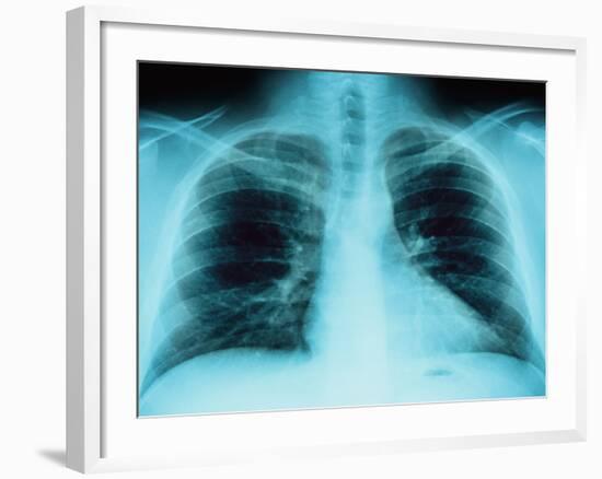 X-Ray of Dark Lungs-Robert Llewellyn-Framed Photographic Print