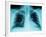 X-Ray of Dark Lungs-Robert Llewellyn-Framed Photographic Print