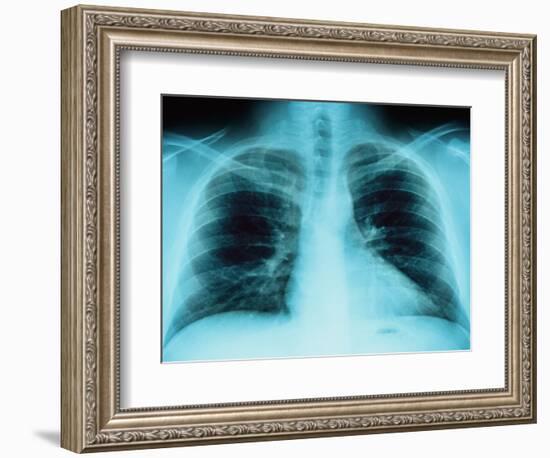 X-Ray of Dark Lungs-Robert Llewellyn-Framed Photographic Print