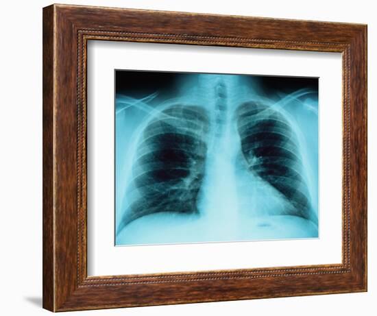 X-Ray of Dark Lungs-Robert Llewellyn-Framed Photographic Print