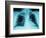 X-Ray of Dark Lungs-Robert Llewellyn-Framed Photographic Print