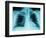 X-Ray of Dark Lungs-Robert Llewellyn-Framed Photographic Print