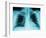 X-Ray of Dark Lungs-Robert Llewellyn-Framed Photographic Print